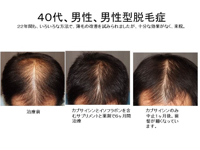 カプサイシン中止による増悪