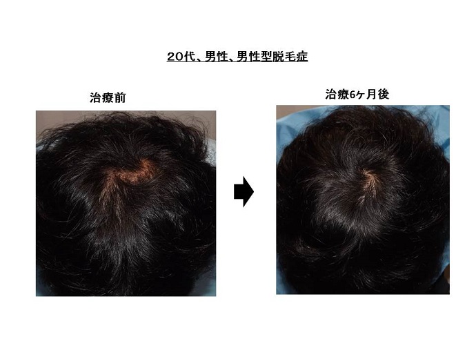 脂漏性皮膚炎にも効果