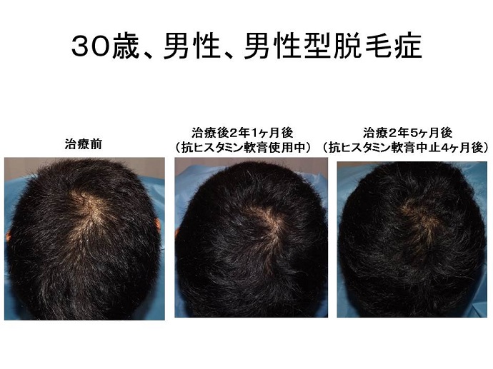 かゆみどめ軟膏中止で改善