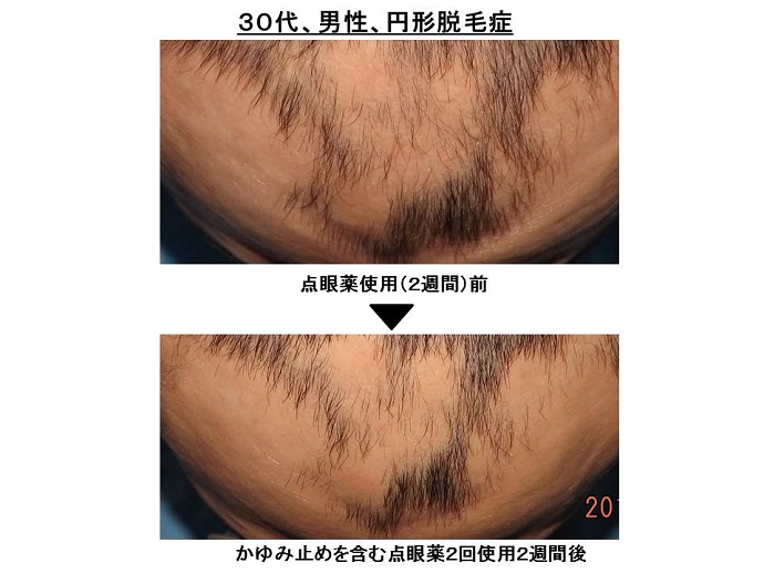 目薬で脱毛