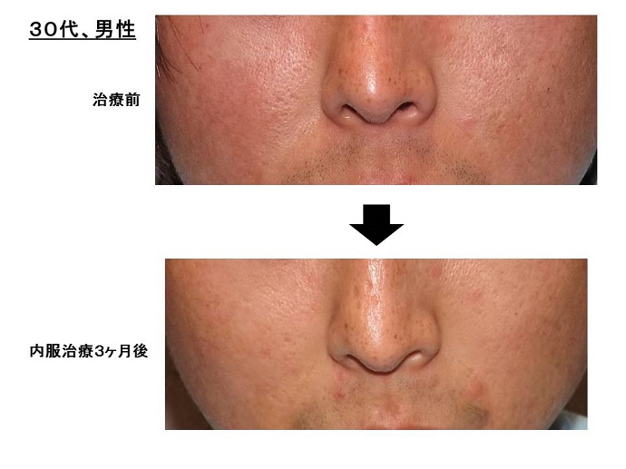 アトピー性皮膚炎への内服治療効果