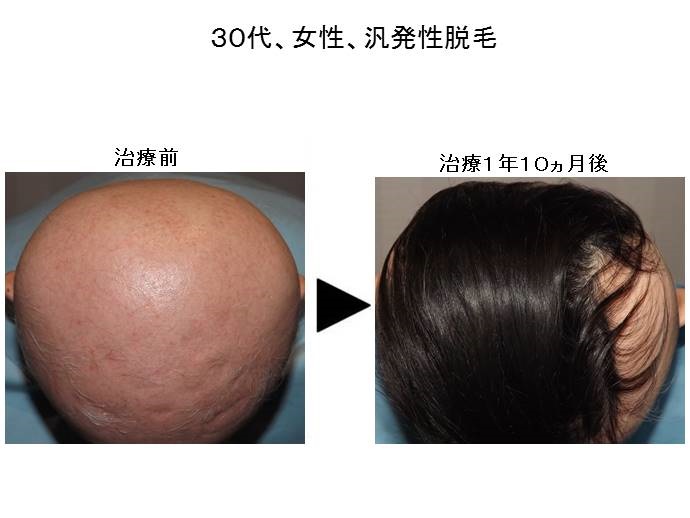 汎発性脱毛症改善