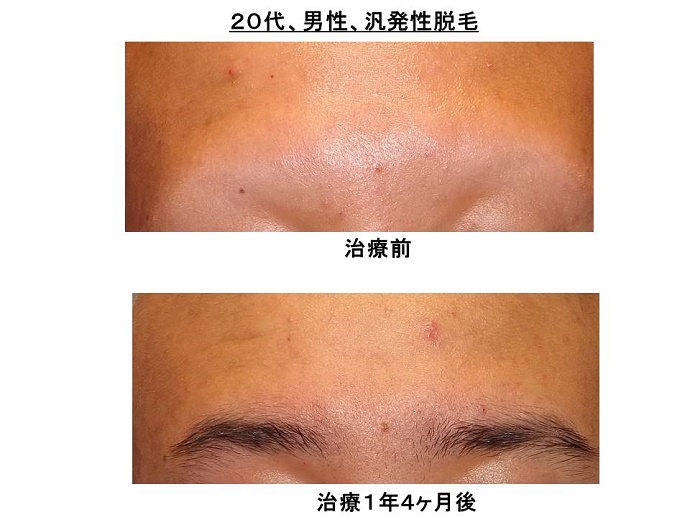 眉毛も生える