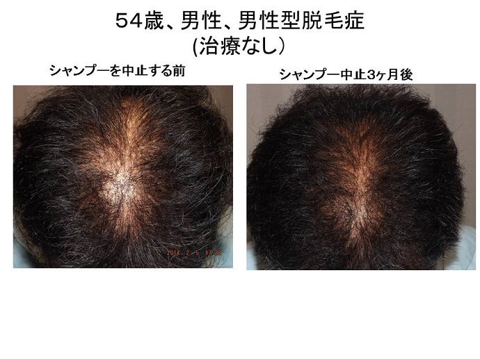 シャンプー中止で増毛