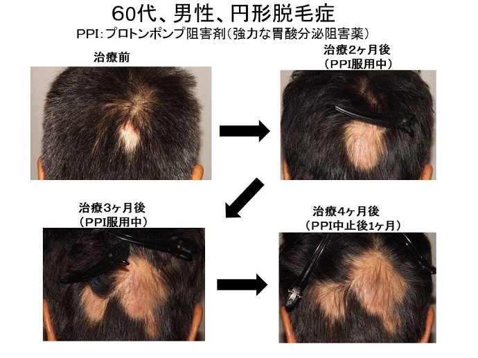 プロトンポンプ阻害剤の影響
