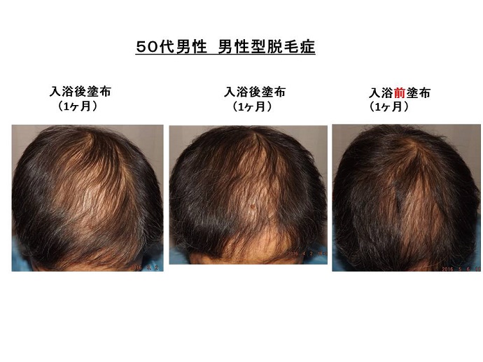 入浴前Pジェル塗布効果