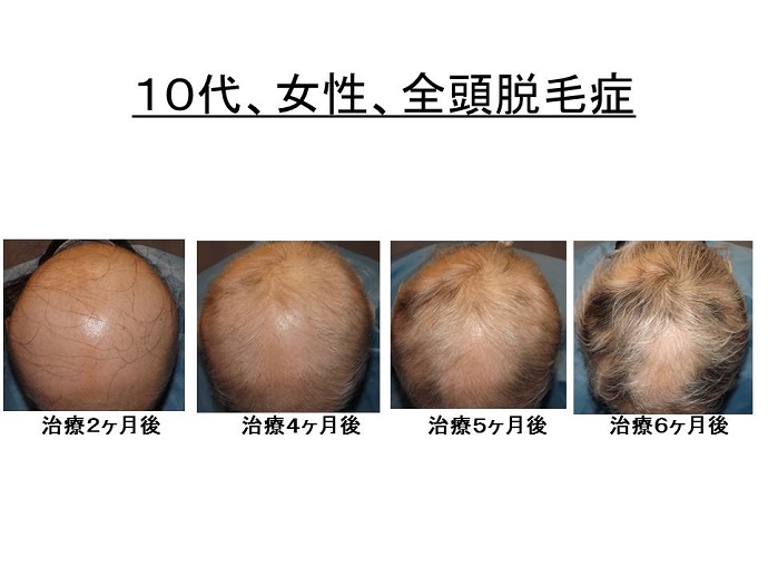 治療により、初めは白髪が生えてきても、徐々に黒くなり、黒い毛も生え