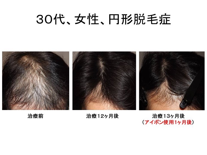 アイボンで円形脱毛症""