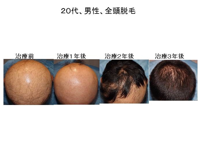 アレグラで脱毛"