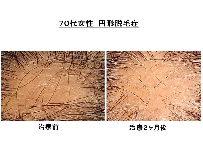 ”円形脱毛症改善"