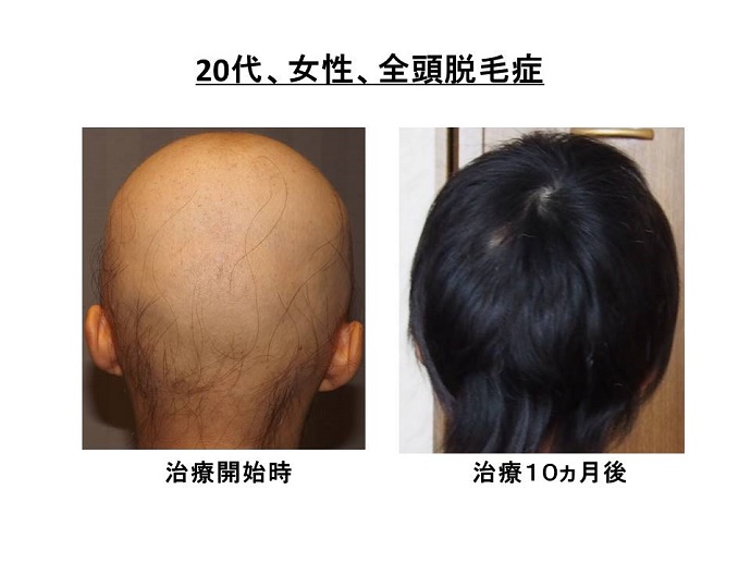 円形脱毛症"width="690"