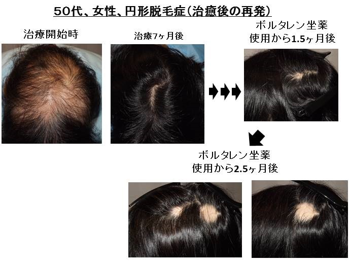 Enkeidatumoushou saihatu ボルタレン坐薬の副作用で円形脱毛症再発""