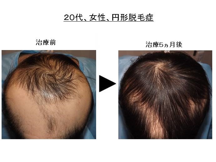円形脱毛症　病院""
