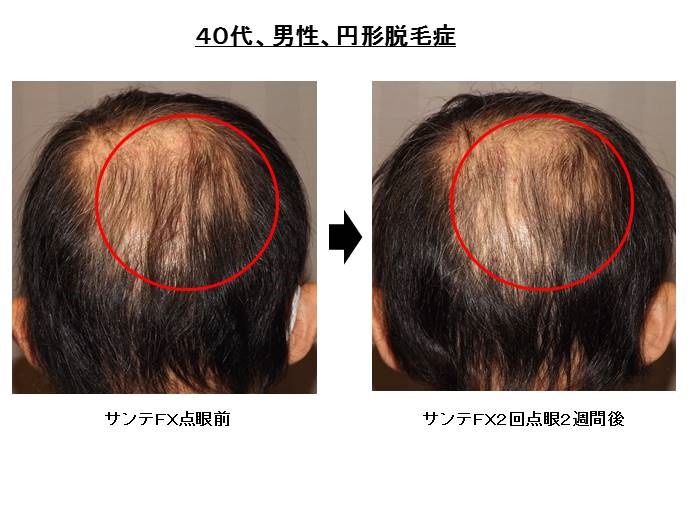 抗ヒスタミン剤で円形脱毛症発症""