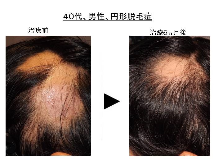 円形脱毛症改善""title="enkeidatumoushou
