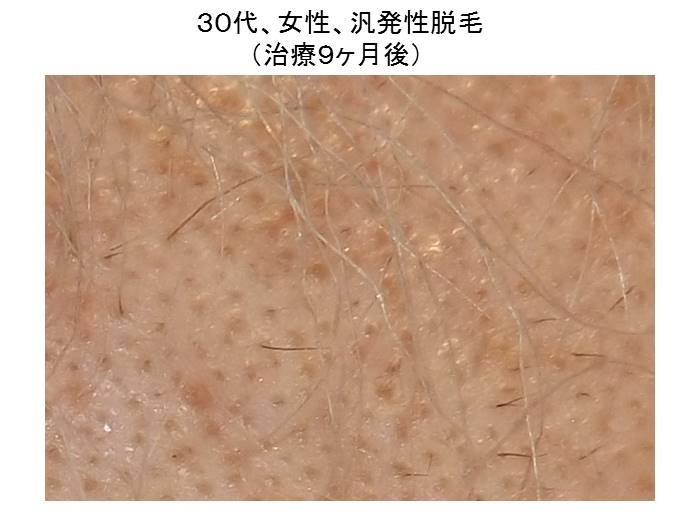 汎発性脱毛"