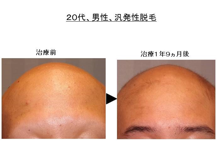 hanpatuseidatumou kaizen 汎発性脱毛 治療効果""
