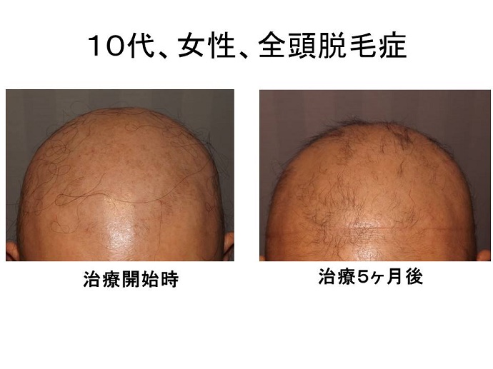 全頭脱毛症改善""