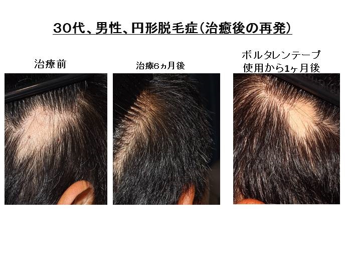 痛み止めで円形脱毛症再発"width="690"