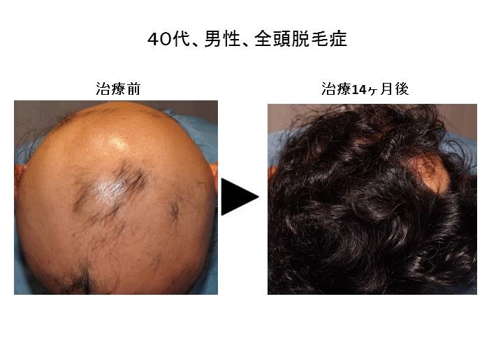 全頭脱毛症""