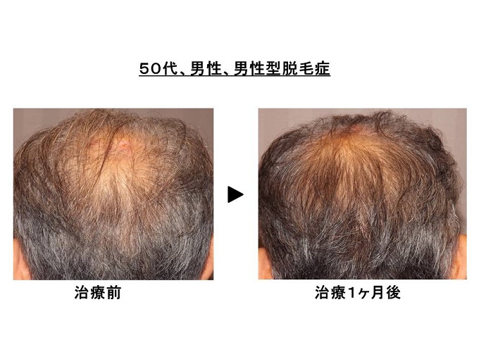 男性型脱毛症の治療効果"width="690"