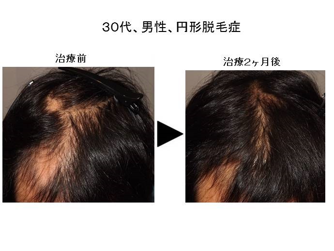 円形脱毛症治療""
