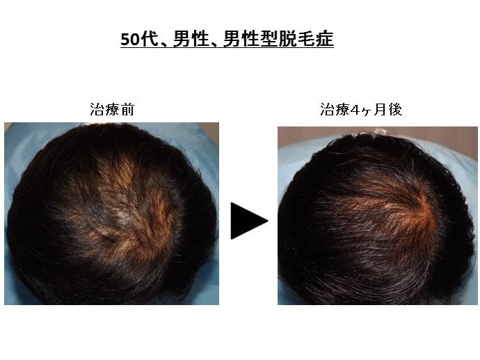 男性型脱毛症　治療""