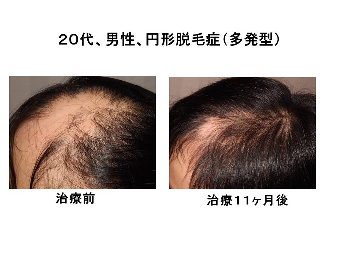 円形脱毛症　病院""