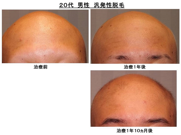 hanpatuseidatumou kouka 20ys male 汎発性脱毛 改善""