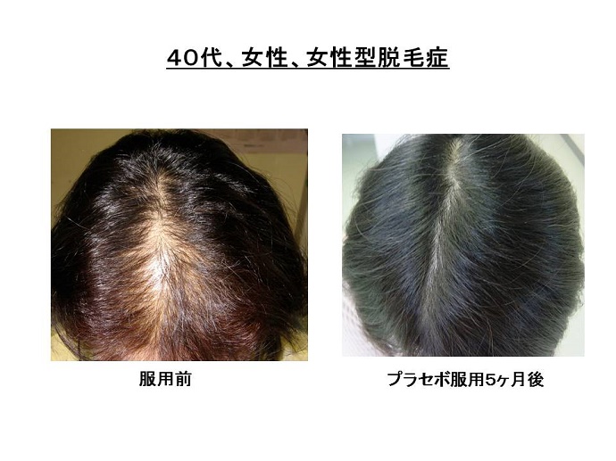 女性の脱毛症""