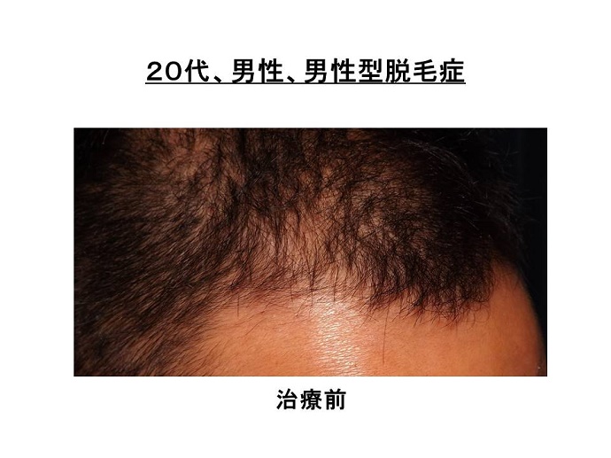 男性型脱毛症""