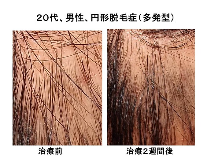 円形脱毛症　名医""