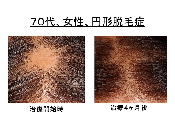 円形脱毛症　名医""