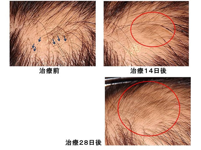 円形脱毛症　病院""