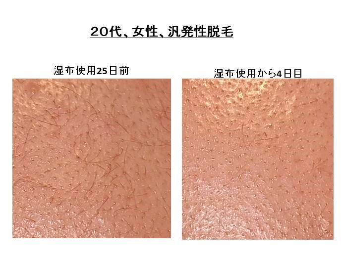 hanpatuseidatumou byouinn 円形脱毛症 名医""