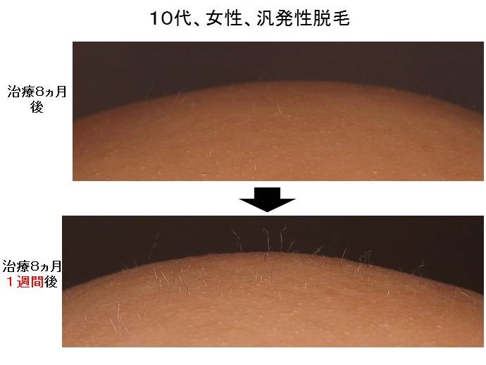 円形脱毛症　名医""