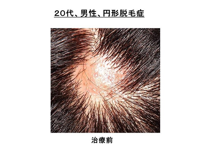 円形脱毛症""