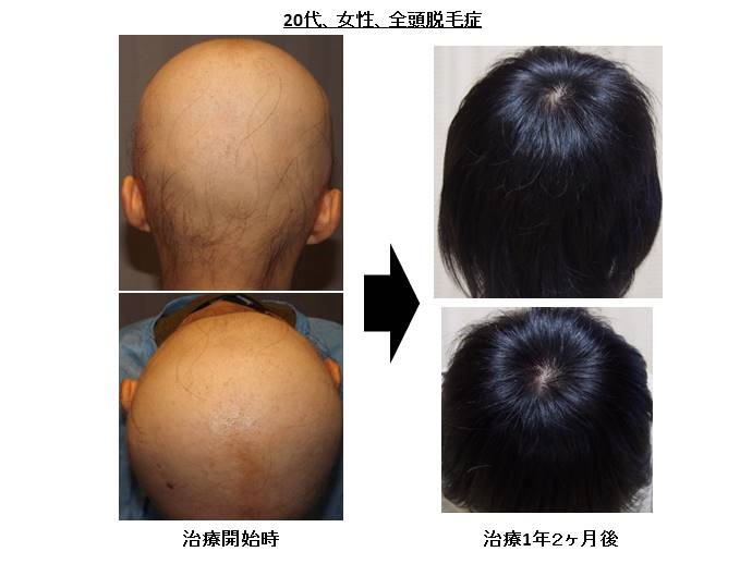 全頭脱毛症　病院""