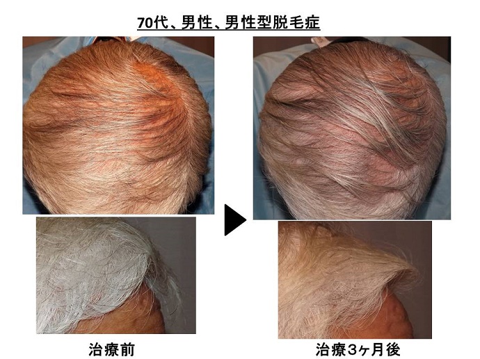 男性型脱毛症　名医""