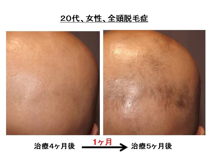 円形脱毛症　名医""