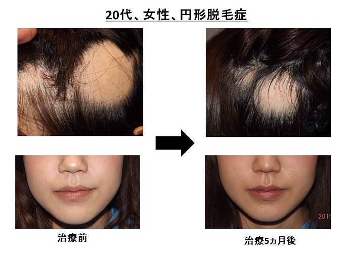 円形脱毛症　名医""