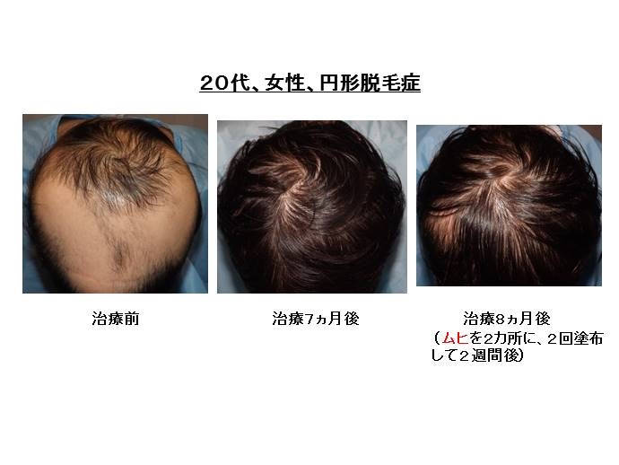 円形脱毛症　名医""