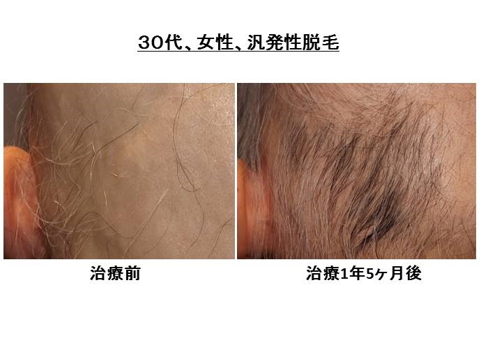 汎発性脱毛　名医""