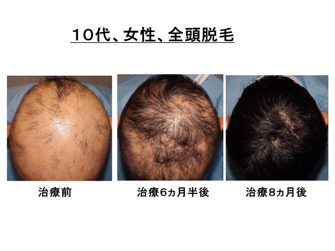 全頭脱毛症　病院""