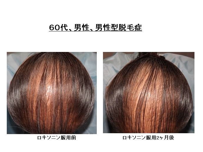 痛み止めで脱毛""