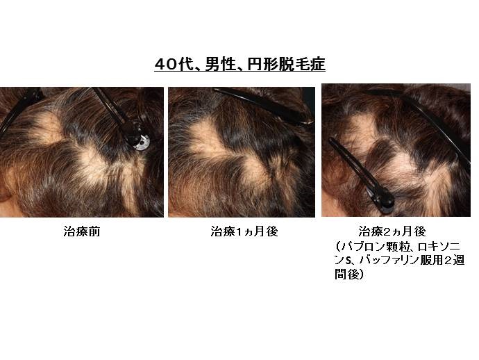 円形脱毛症　名医""