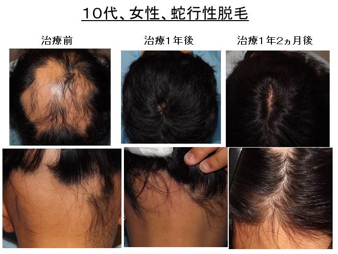 円形脱毛症　名医""