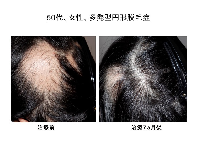 後頭部の大きな円形脱毛症 治療7ヵ月で 明らかに改善 患者様からの声 メディア掲載 クリニックからのお知らせ 名古屋kクリニック