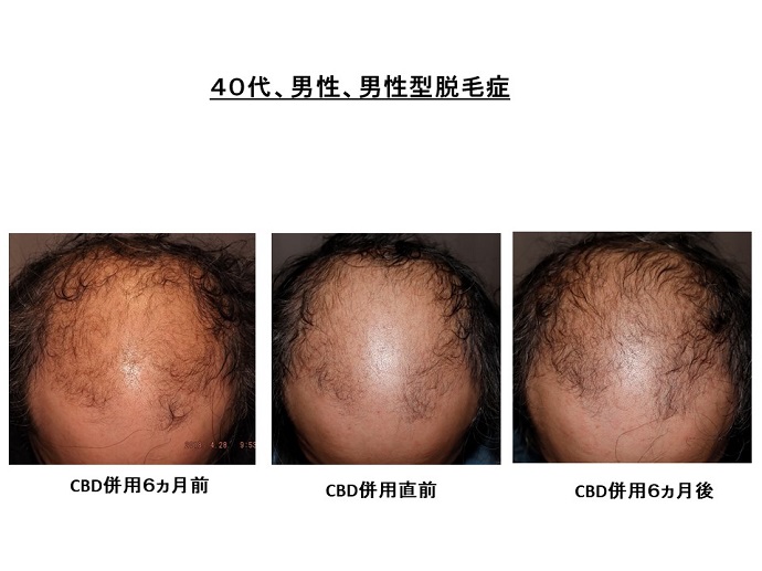 カンナビジオールの併用で 重症の脱毛症が改善 患者様からの声 メディア掲載 クリニックからのお知らせ 名古屋kクリニック