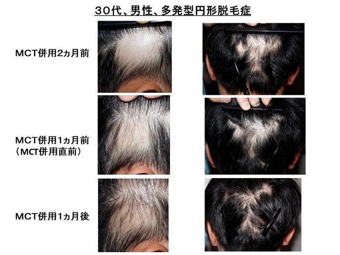 Mctオイル併用で 円形脱毛症の改善が促進 患者様からの声 メディア掲載 クリニックからのお知らせ 名古屋kクリニック